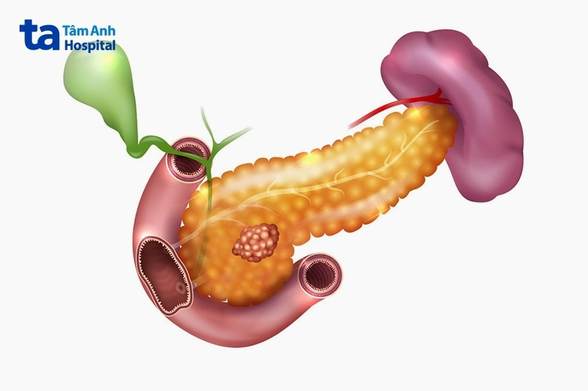 Hình ảnh minh họa vị trí khối u nhỏ phát triển bên trong tuyến tụy