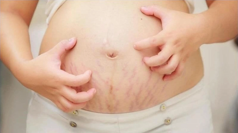 Hoạt chất trong rau má giúp ngăn ngừa rạn da và thúc đẩy lành vết thương