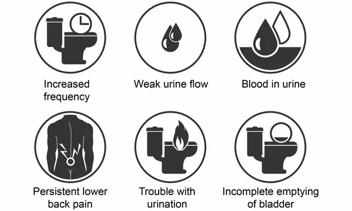 Infographic liệt kê các triệu chứng phổ biến của ung thư tuyến tiền liệt liên quan đến đường tiết niệu.