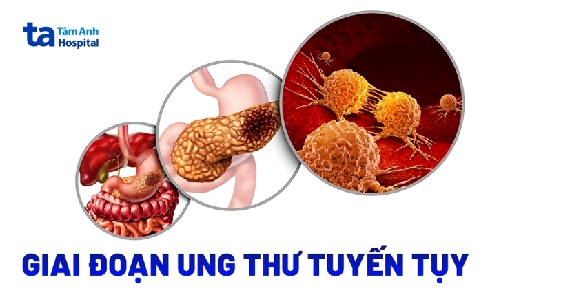 Infographic minh họa các giai đoạn phát triển của ung thư tuyến tụy