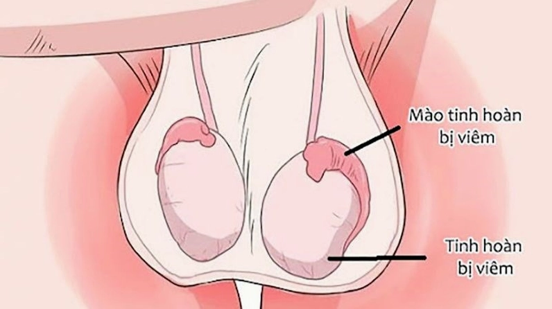 Lá lốt có tác dụng điều trị viêm tinh hoàn