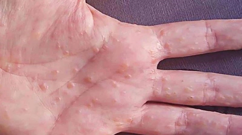 Lá lốt hỗ trợ điều trị tổ đỉa ở bàn tay