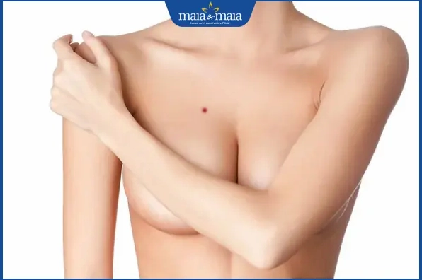 Nốt ruồi son ở ngực nữ