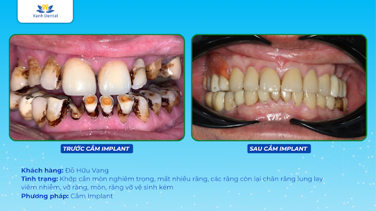 Bạn tìm địa chỉ tẩy trắng răng Nhổn uy tín? Khám phá Nha Khoa Xanh Dental CS2 (93 Phố Nhổn) - tẩy trắng răng Laser không đau, bật 2-3 tông nhanh, giá tốt.